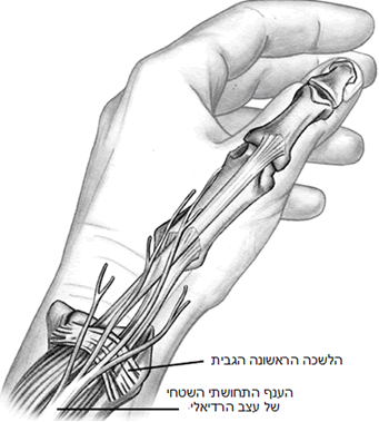 מחלה ע”ש דה-קרווין