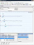 בדיקת EMG –NCV