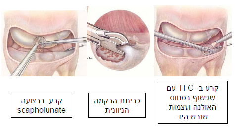 אינדיקציות לארטרוסקופיה אבחנתית של שורש היד